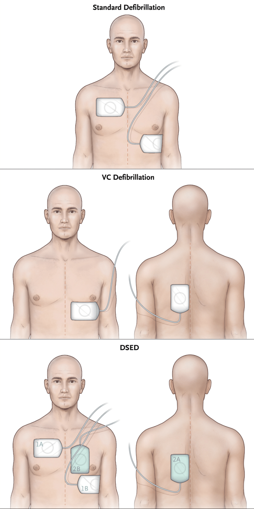 double défibrillation